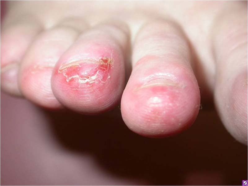 Chilblains
