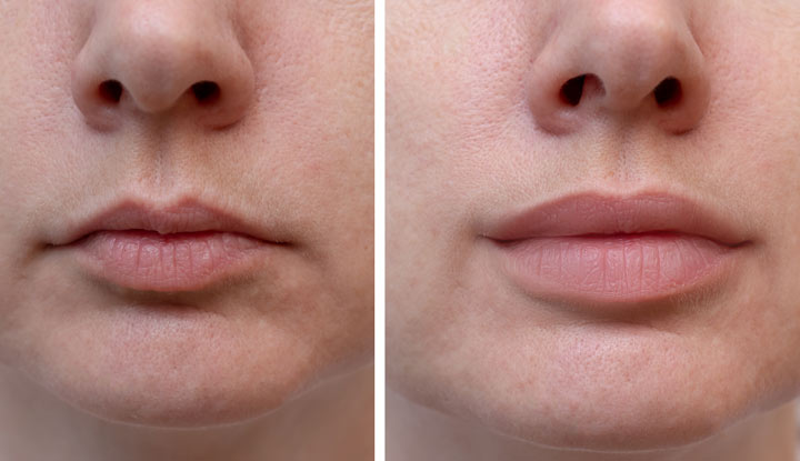 Lip Fillers
